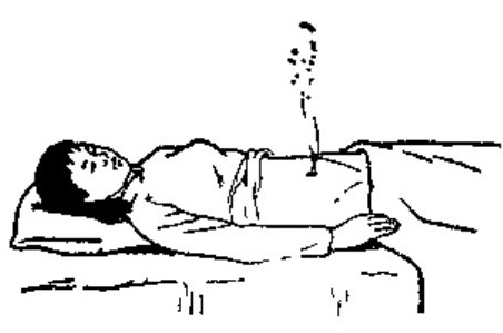 Moxibustion Therapy