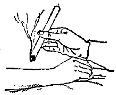 Moxibustion Therapy