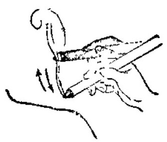 Moxibustion Therapy