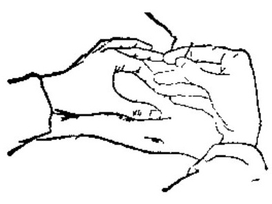 Skin-Stretching Insertion